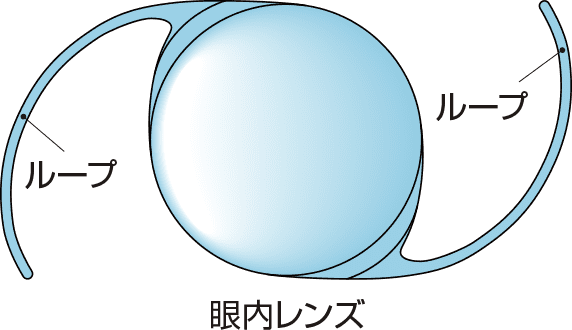 眼内レンズの説明画像