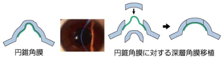 角膜比較2