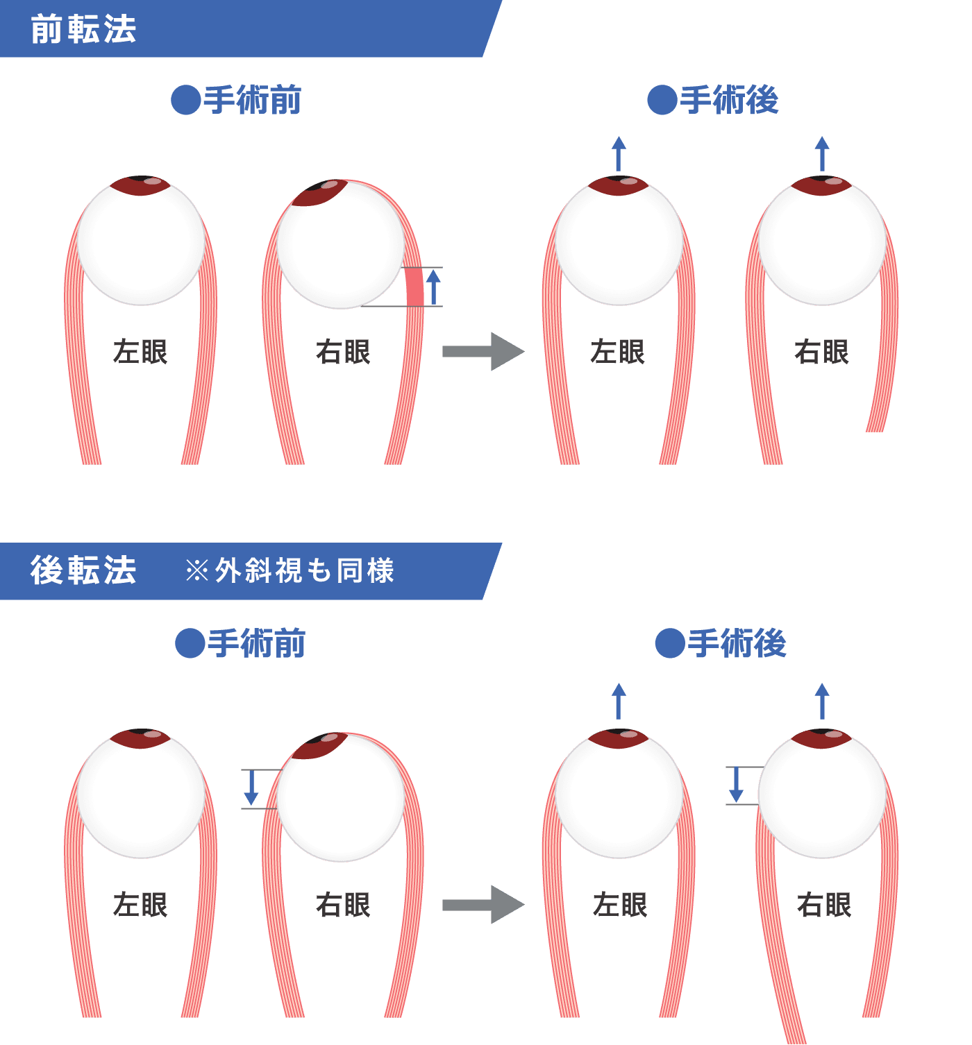 前転法と後転法のイメージ（内斜視の場合）